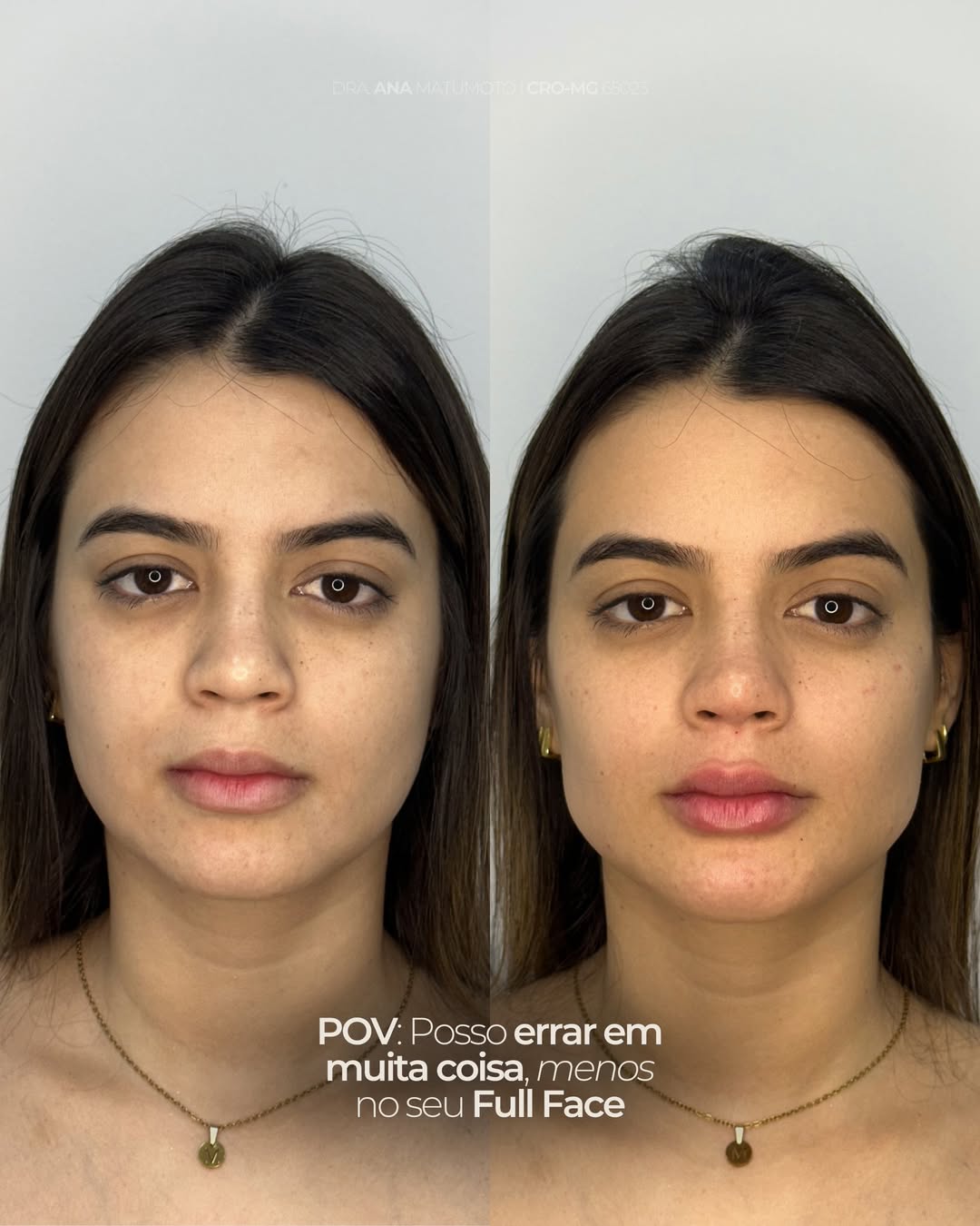 Antes e depois — caso 4